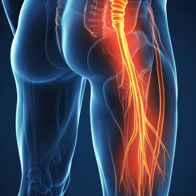 signs your leg pain may actually sciatica